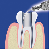 Dnešní endodoncie, kde je a kam směřuje
