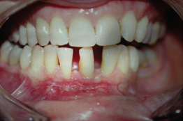 Dlahovanie zubov pri liečenej parodontitíde