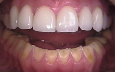 Poruchy příjmu potravy způsobují erozi zubních tkání