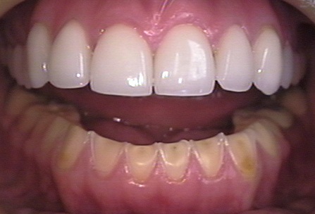 Odolný materiál, který sníží citlivost zubů