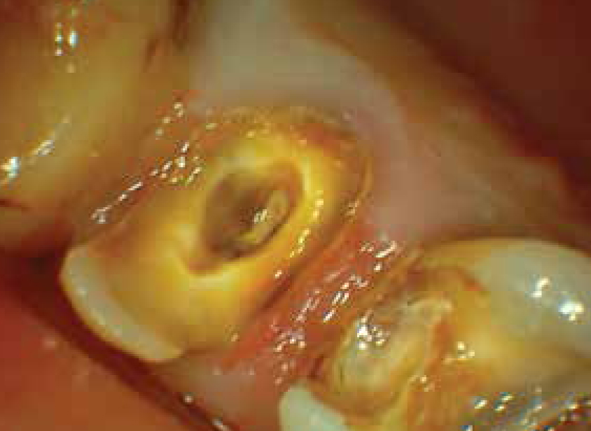 Klinické hodnocení adheziv obsahujících etanol a adheziv na bázi acetonu při restaurování zubu